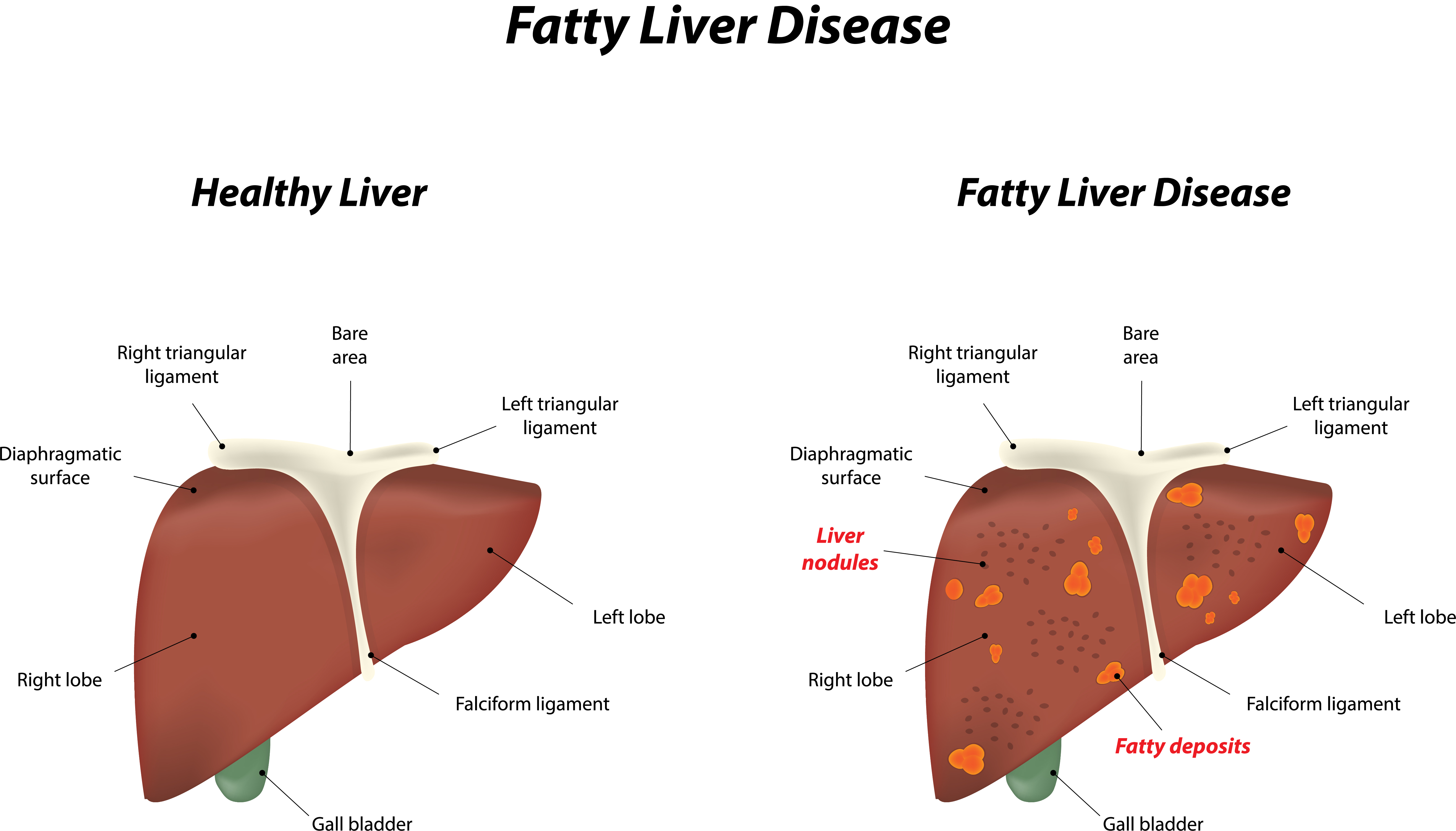 what is liver disease